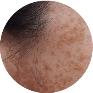 Dark Spots