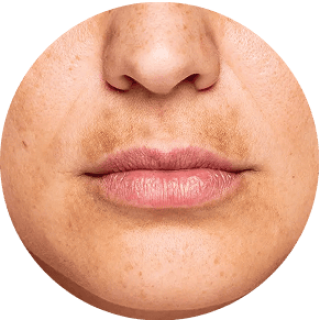 Uneven Skin Tone